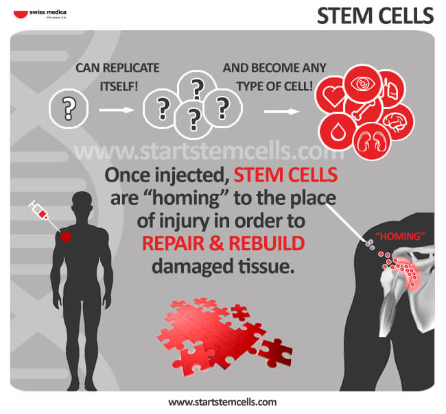 Stem Cell treatment