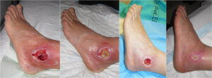 Diabetic foot-treatment with stem cells